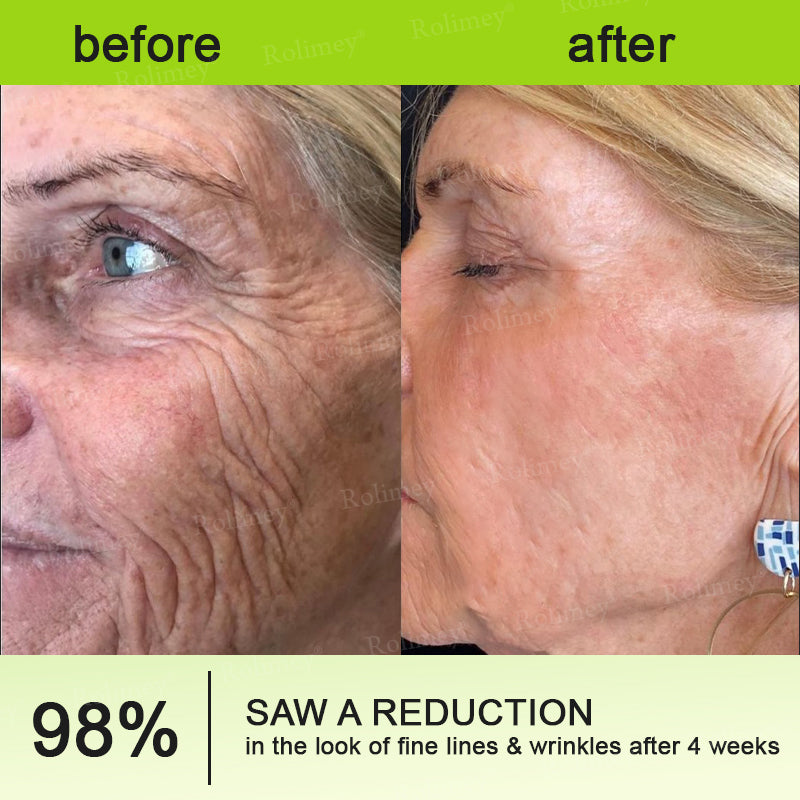 👍🌟💫Made and shipped from Canada 💫Rolimey® Botox & Vita-A Retinol Shot Wrinkle-Lift Tightening cream - Last Day Promotion 70% OFF
