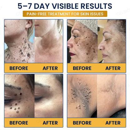 🙌✨GFOUK® 7-Day MicroNeedle Wart & Skin Tag Removal Patch