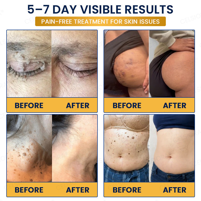 🙌✨GFOUK® 7-Day MicroNeedle Wart & Skin Tag Removal Patch