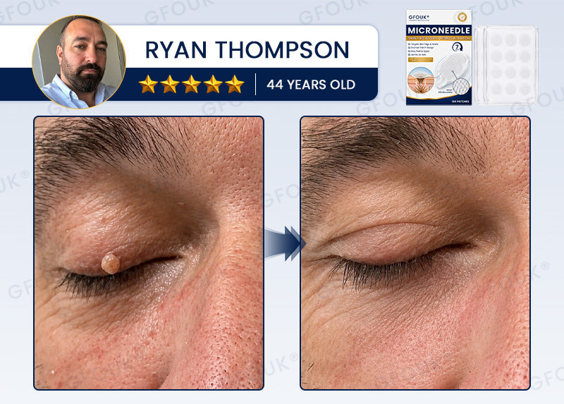 🙌✨GFOUK® 7-Day MicroNeedle Wart & Skin Tag Removal Patch