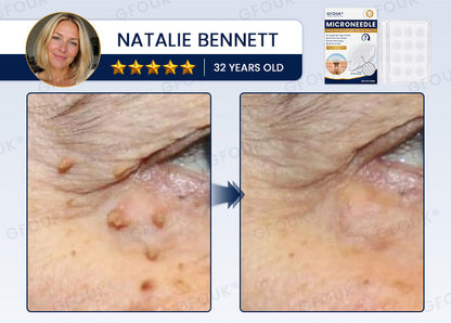 🙌✨GFOUK® 7-Day MicroNeedle Wart & Skin Tag Removal Patch