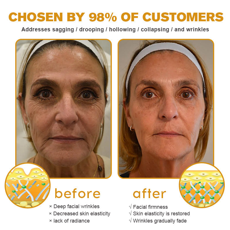 (💎🔥🌿Made and shipped from Canada👨‍⚕️) Furzero™ Botox Bee Venom Wrinkle Removal Cream- LAST DAY 70% OFF
